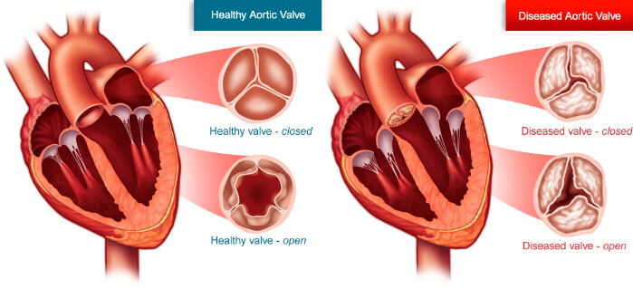 Aortic valve stenosis illustration
