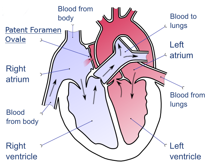 Diagram of a patent foramen ovale in the heart