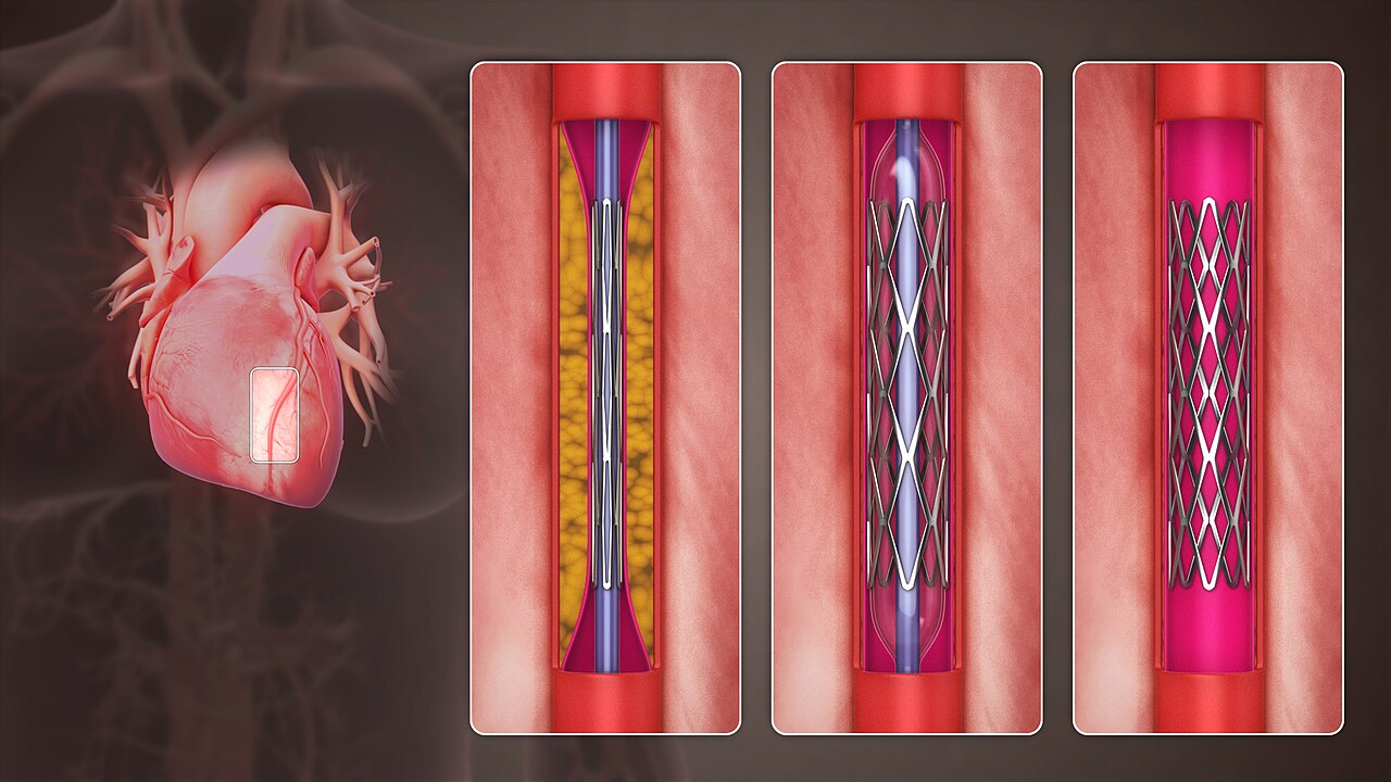 Illustration of a percutaneous coronary intervention with a coronary stent