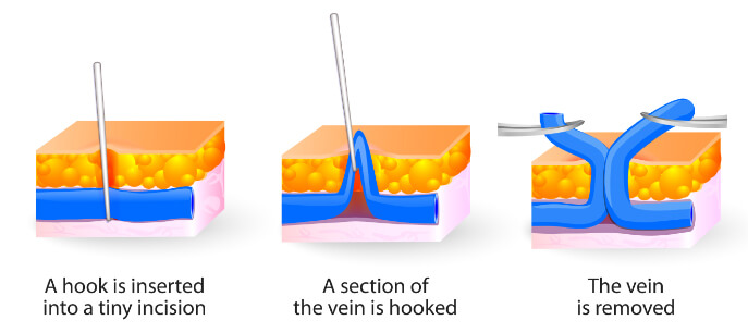 Leg after microphlebectomy procedure