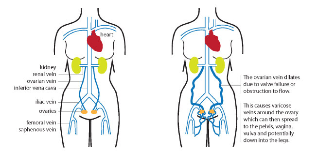 Pelvic congestion syndrome illustration