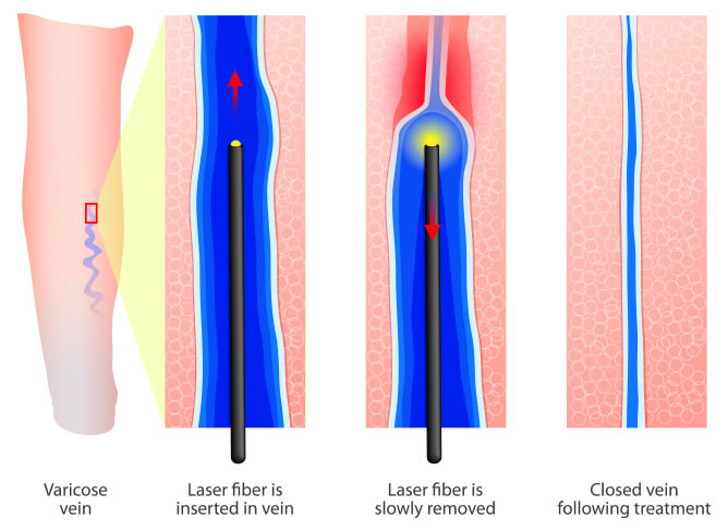 Leg after radiofrequency ablation treatment