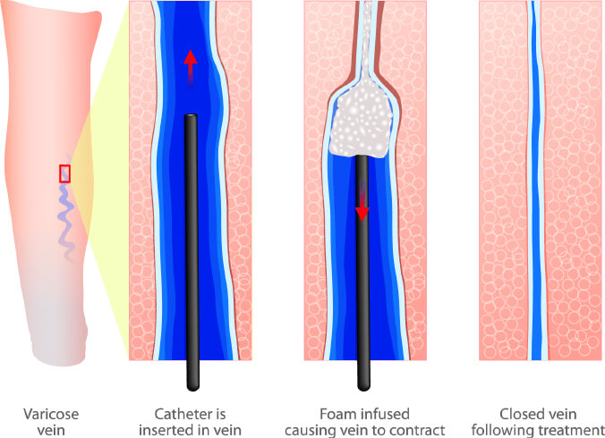 Leg after sclerotherapy treatment