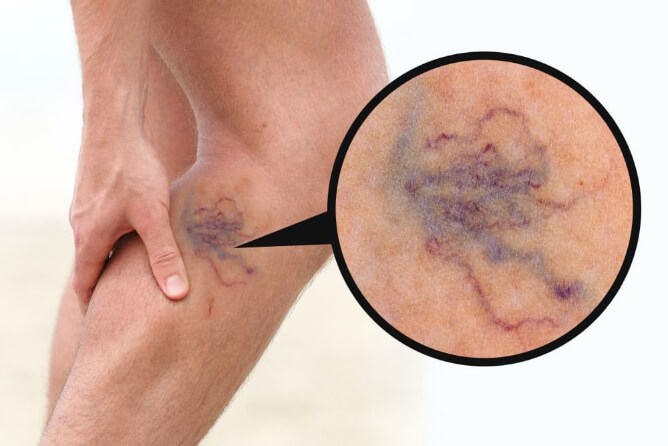 Leg with spider veins before treatment