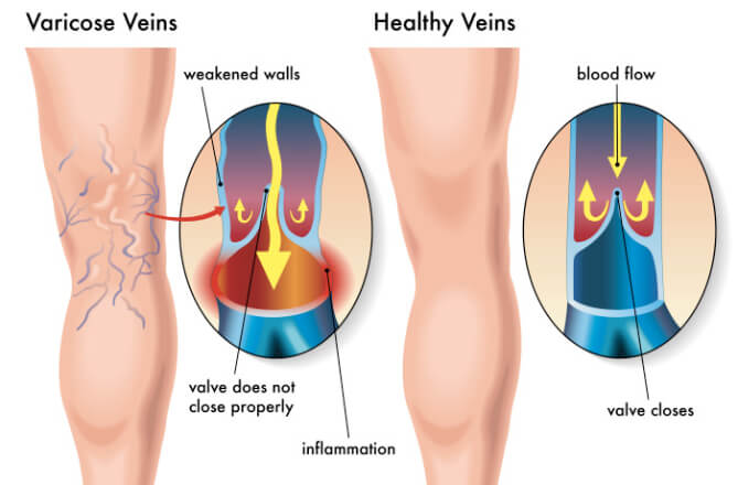 Leg with varicose veins before treatment