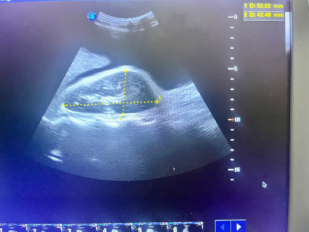 Renal ultrasound image of a kidney